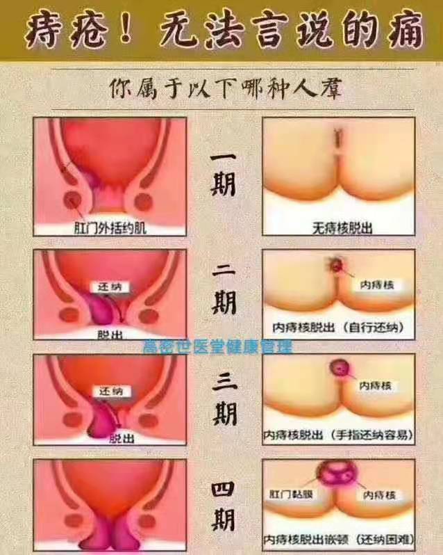 痔瘡病癥圖.jpg